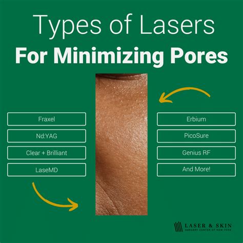 The Ultimate Guide To Laser Treatment For Shrinking Pores Laser Ny