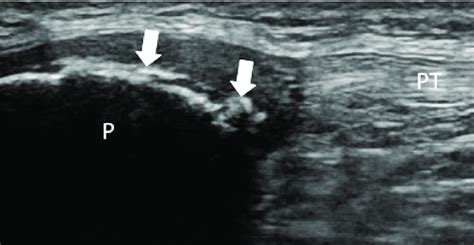 Sinding Larsen Johansson Disease Longitudinal Ultrasonographic Image