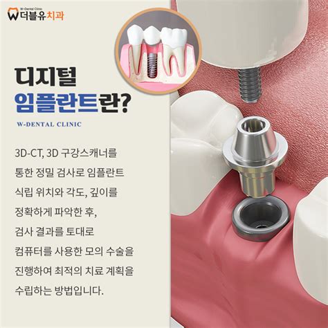 더블유치과의원 임플란트 재료 고가 회사의 제품이 좋다 치아 관리 Tip