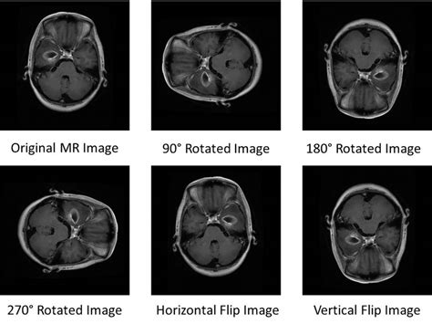 Sample Brain Tumor Dataset From Figshare A Glioma B Meningioma C