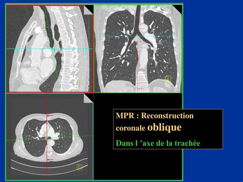 Ppt Scanner Thoracique Anatomie Du Thorax En Coupes Powerpoint