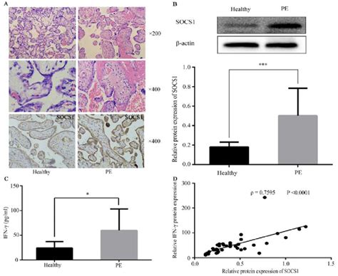 SOCS1 and IFN γ are highly expressed in the placenta of patients with