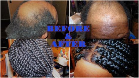 Hair Loss Alopecia Man Box Braids Transformation Technique Youtube