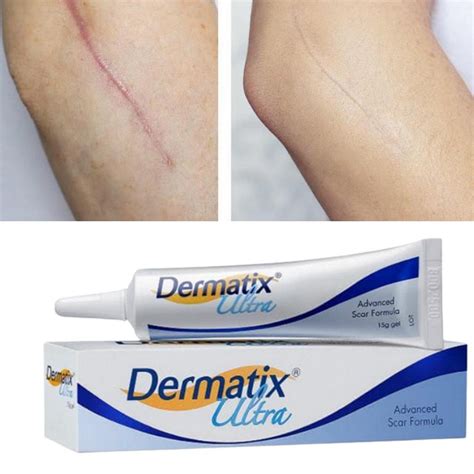 Jual Dermatix Ultra Gel 15g Original Penghilang Bekas Luka Keloid Stretchmark Shopee