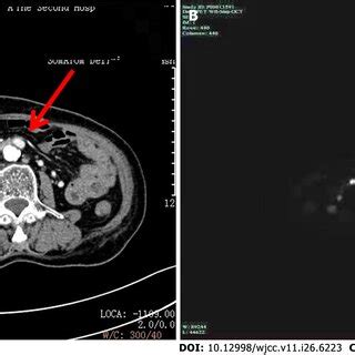 Imaging Findings A Contrast Enhanced Computed Tomography CT Arrow