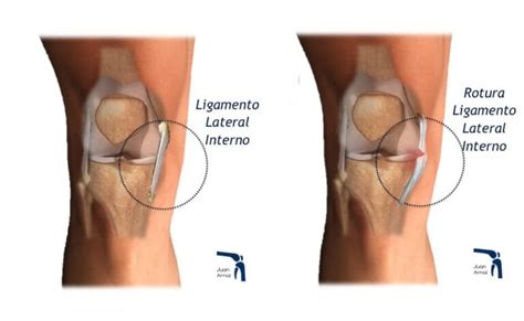 Distensi N Del Ligamento Lateral Interno De La Rodilla Normalweb Es