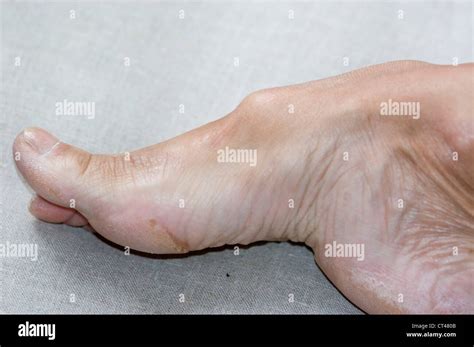 Podiatry High Arches Hi Res Stock Photography And Images Alamy