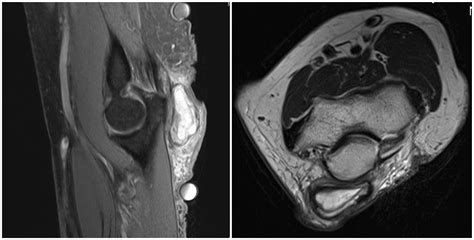 Olecranon Bursitis Xray