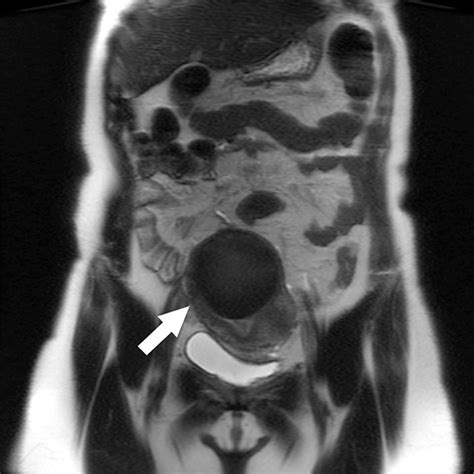 Increased Speed And Image Quality For Pelvic Single Shot Fast Spin Echo