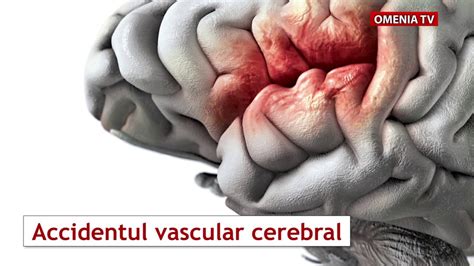 Accidentul Vascular Cerebral YouTube