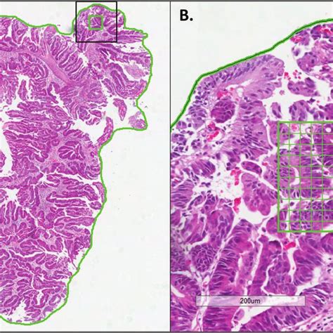 H E Stained Tissue Section Of A Biopsy Specimen Annotated For