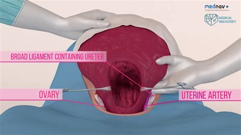 Cesarean Section Technique With Diagram