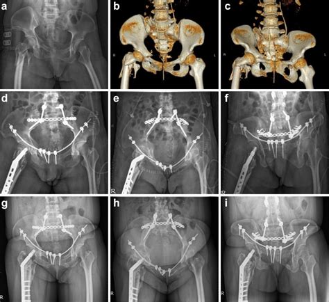 Conventional Plate Fixation Versus Minimally Invasive Modified Pedicle