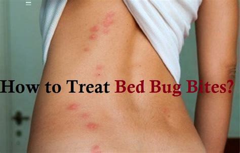 How to Treat Bed Bug Bites?