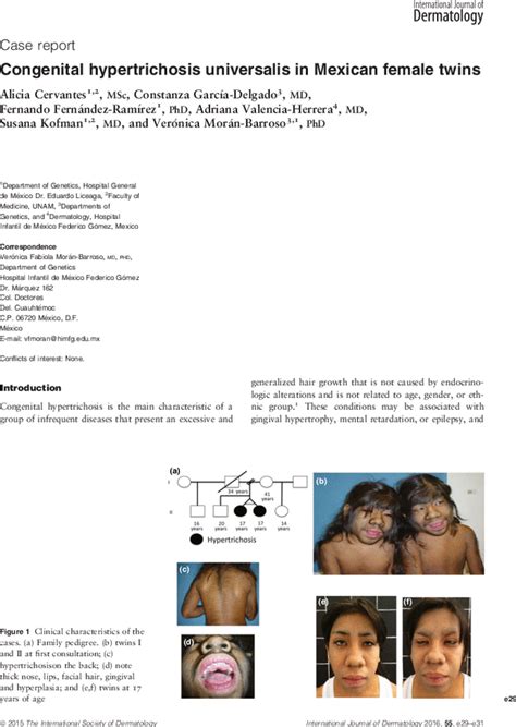 Congenital Hypertrichosis Universalis In Mexican Female Twins