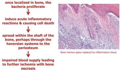 Msk Pathology Bone Flashcards Quizlet