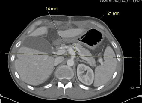 Axial view, illustrating celiac artery aneurysm. | Download Scientific ...