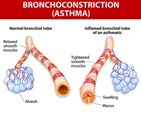 Asthma Signs And Symptoms Causes Treatment Medications