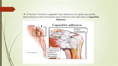 Capsulitis Adhesiva O S Ndrome De Hombro Congelado Pptx