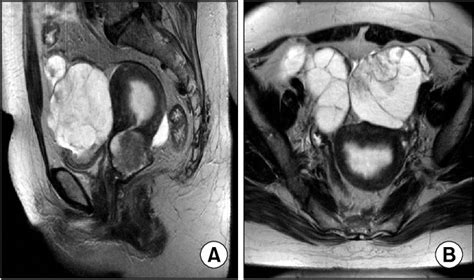 Sagittal T2 Weighted Image A Shows A Lobulated Mass In The Uterine