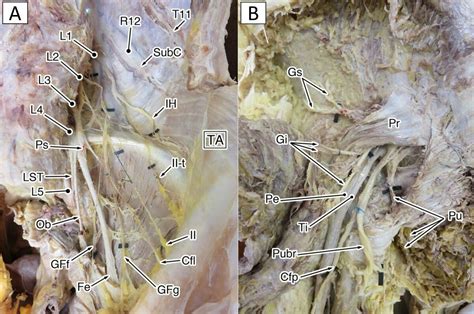 Lumbosacral Plexus Wikimsk