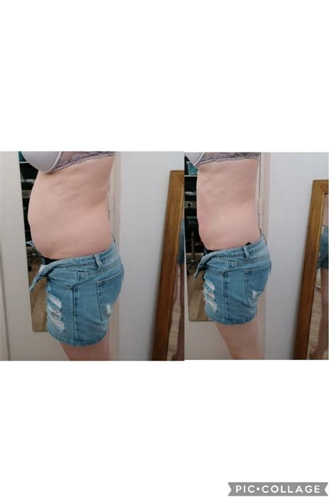 Avant Apr S Lipocavitation Radiofr Quence Lifting Colombien