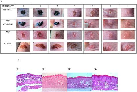 Skin Abrasion Infection