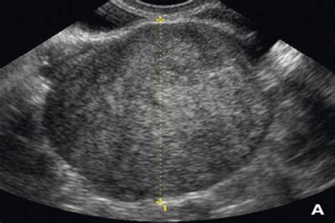 Correlación Ultrasonográfica E Histopatológica De Los Tumores De Ovario