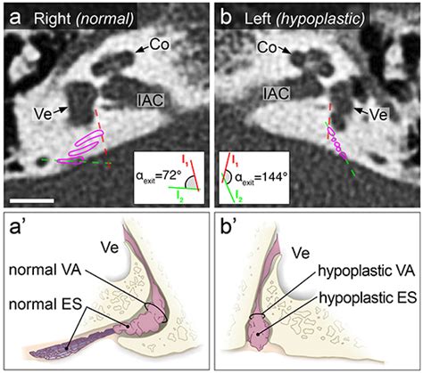 Frontiers Radiological Configuration Of The Vestibular Aqueduct