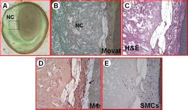 How is ruptured plaque differentiated from vulnerable plaque?