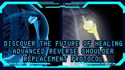 Reverse Shoulder Replacement Protocol Comprehensive Guide