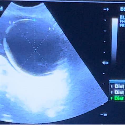 Ultrasonography Showing The Uterus Cervix And Vagina Without