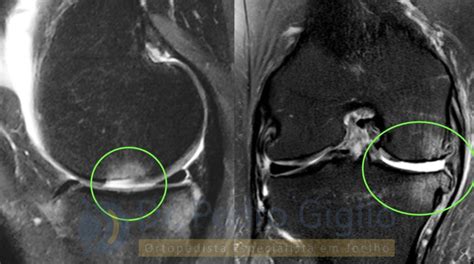 Desgaste Do Joelho E Cartilagem Desgastada Dr Pedro Giglio
