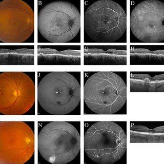 Multimodal Imaging Ae Of The Right Eye Of A Year Old Female