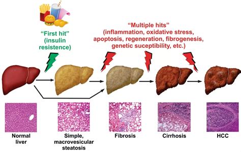 【gene Of The Week】非酒精性脂肪肝靶点之hif 1α 哔哩哔哩