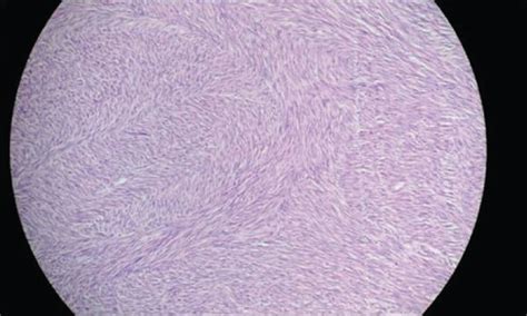 Histopathology Sections Showing Spindle Shaped Tumour Cells Arranged In