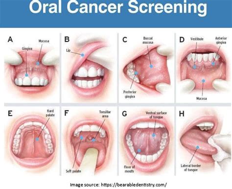 Understanding Precancerous Oral Cancer Stages Dr Sandeep