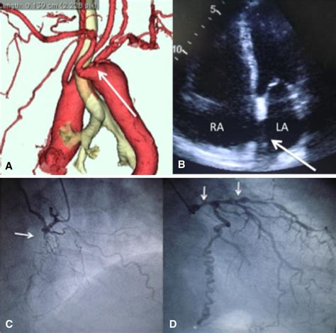 Two Stage Hybrid Repair For A Kommerell Diverticulum In A Right Sided Aortic Arch Associated