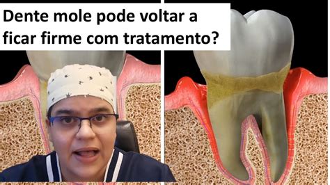 É possivel tratamento o dente mole ficar firme denovo Master