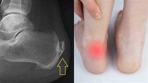 Calcification In Achilles Tendon Causes Treatment And Physiotherapy