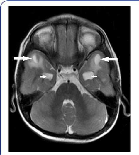 Figure 1 from MRI Features of a Rare Entity-Cystic Leukoencephalopathywithout Megalencephaly ...