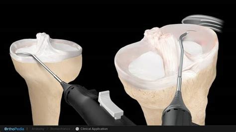 Meniscal Pathology Inside Out Meniscus Repair Using The Zonenavigator