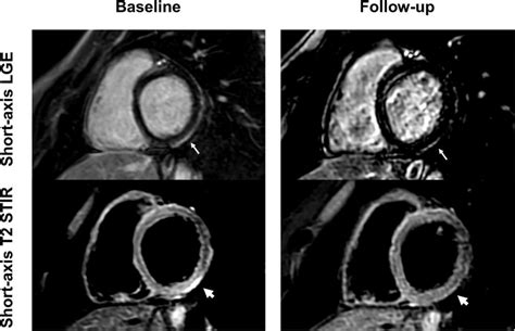 Short Axis Late Gadolinium Enhancement Lge And Short Axis T2 Short