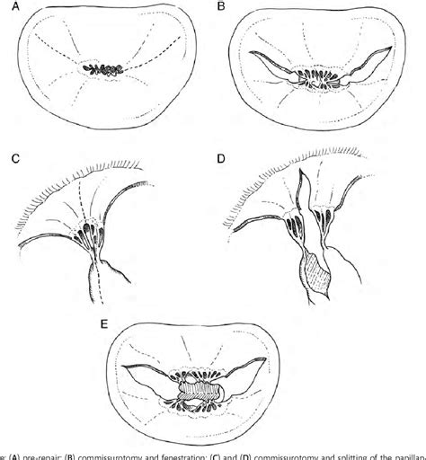 Figure 1 From Long Term Surgical Outcome Of Mitral Valve Repair In