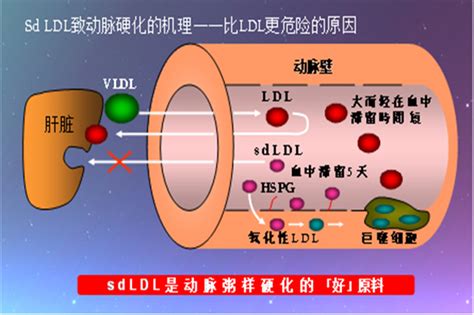 检验科新项目——小而密低密度脂蛋白胆固醇（sdldl C） 特色医疗 北京中医药大学第三附属医院