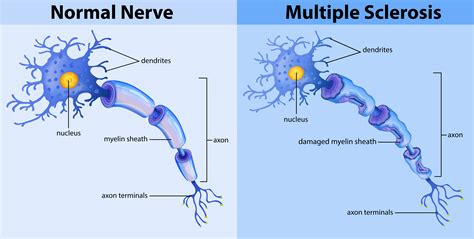 Schematic Diagram Pathophysiology Multiple Sclerosis Pathoph