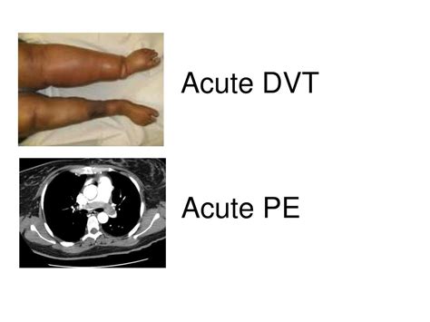 Ppt Management Of Acute Vte Powerpoint Presentation Free Download