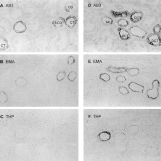 Segmental And Sub Segmental Expression Of Epithelial Membrane Antigen