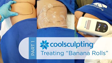 Coolsculpting Treatment Banana Rolls Part Youtube