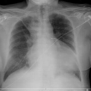 Frontal Chest Radiograph Showing Mild Cardiomegaly And Opacification